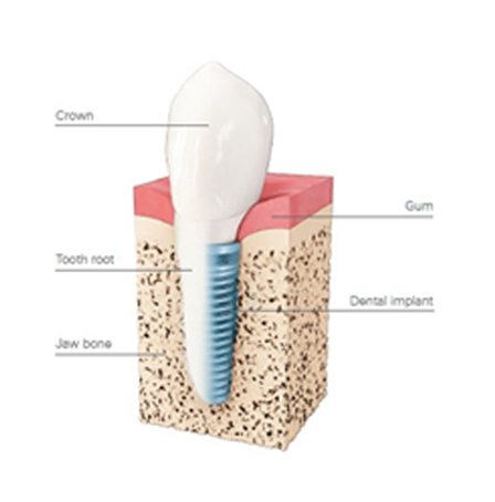 dental implants