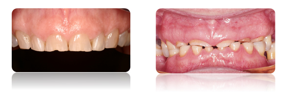 dental implants